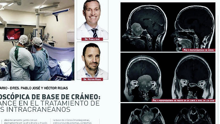 Cirugía endoscópica de base de Cráneo: un gran avance en el tratamiento de los tumores intracraneanos