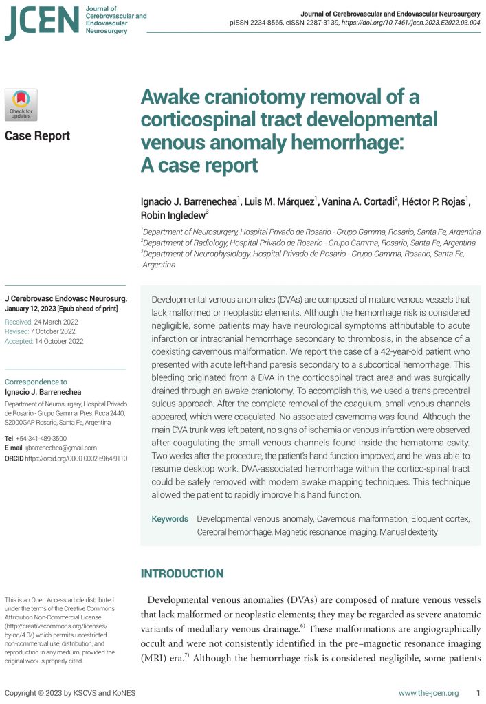 Awake craniotomy removal of a corticospinal tract developmental venous anomaly hemorrhage: A case report